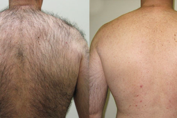 Laser hair removal men Newcastle
